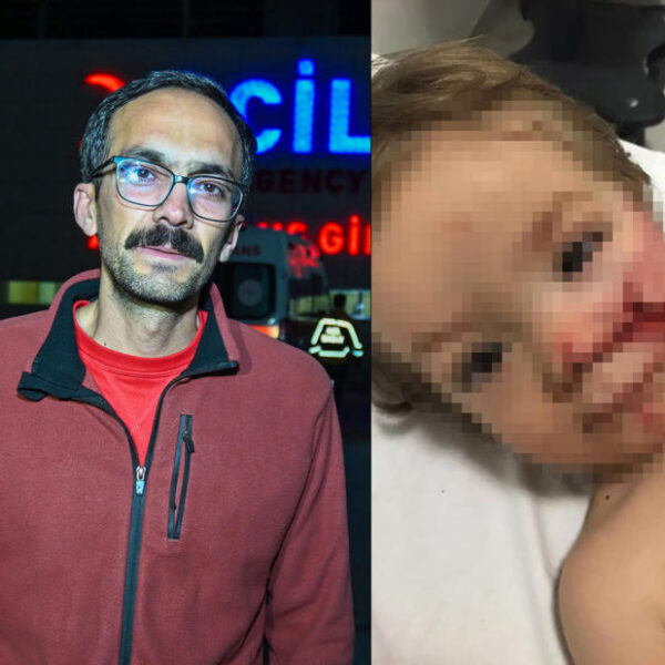 Ankara’da pitbull saldırısı: İki kardeş yaralandı, birinin yüzü ağır hasar aldı.