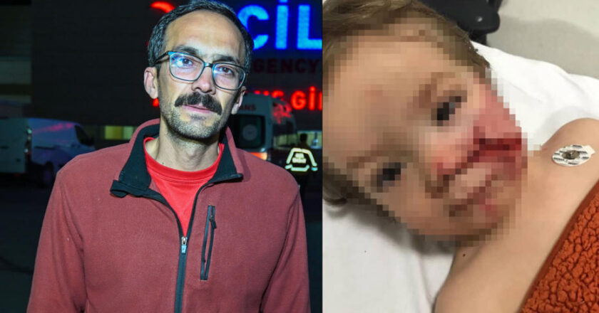 Ankara’da pitbull saldırısı: İki kardeş yaralandı, birinin yüzü ağır hasar aldı.